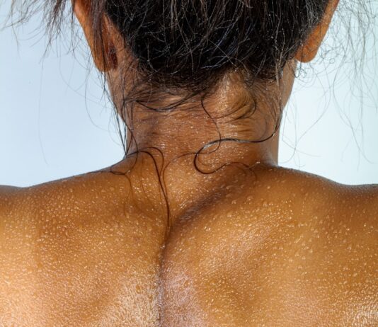 “등이 자꾸 간지러워요”…초여름 ‘땀띠’는 어른도 생깁니다 topless woman with brown hair