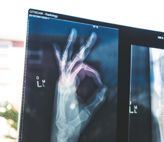 튼튼한 뼈를 위한 골다공증 예방, 지금 시작해야 합니다 citiscan result hand ok