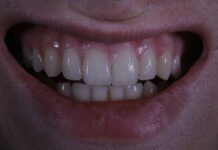 “자고 일어났더니 턱이 뻐근해요”… 스트레스가 부른 ‘이갈이(브럭시즘)’의 진실 a close up of a person's mouth with a missing tooth